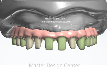 Full Arch Implant Bridge