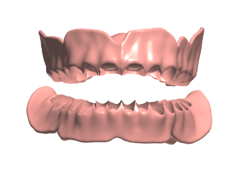 Denture Design