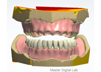 Denture Design