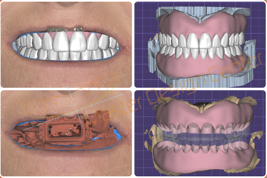 Full Denture Design