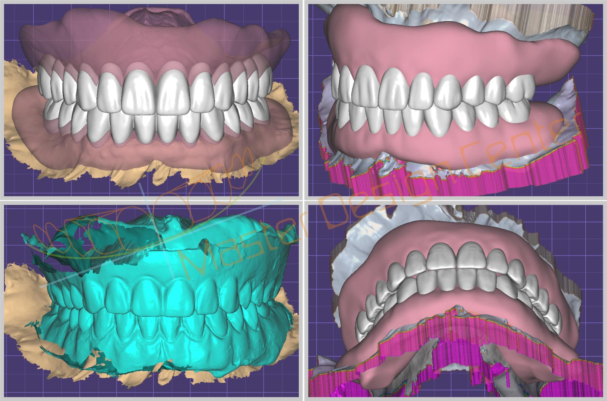 Denture Design